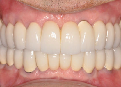 After Dental Implants Full Mouth Reconstruction