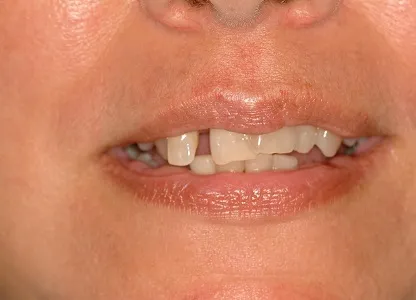 Before Dental Implants Full Mouth Reconstruction