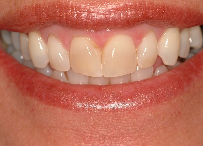 Before Teeth Veneers Case Study Photo