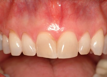 Before Teeth Veneers