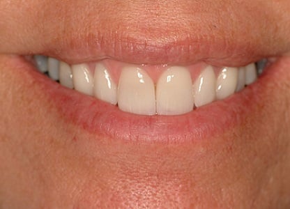 After Teeth Veneers Case Study Photo