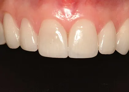 After Teeth Veneers