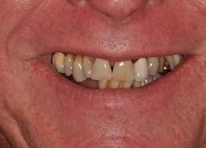 Before Teeth in a Day Case Study Photo