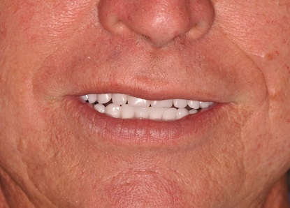 After Teeth in a Day Case Study Photo