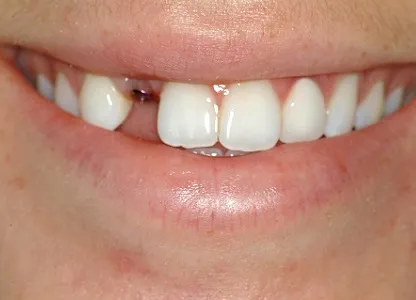 Single Tooth Implants