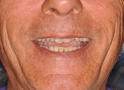 Before Dental Implants Full Mouth Reconstruction