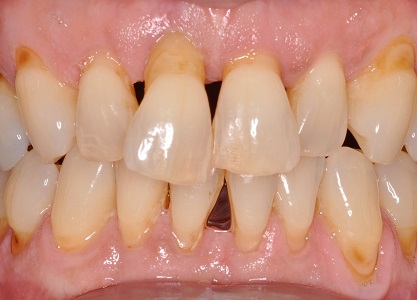 Before Dental Implants Full Mouth Reconstruction