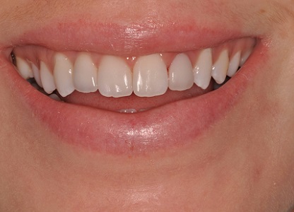 Single Tooth Implants