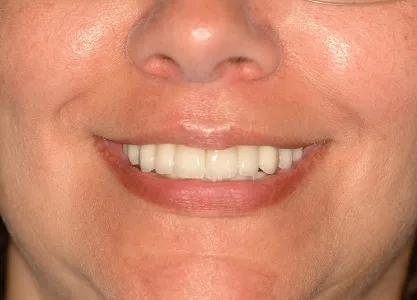 After Dental Implants Full Mouth Reconstruction