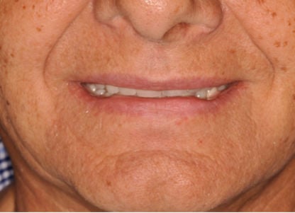 Implant Retained Removable Dentures