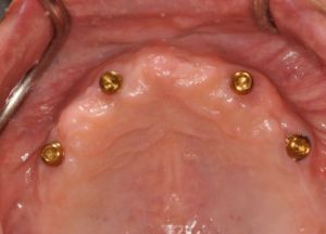 Implant Retained Removable Dentures