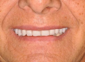 Implant Retained Removable Dentures