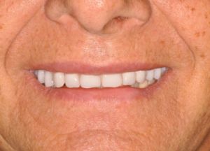 Implant Retained Removable Dentures