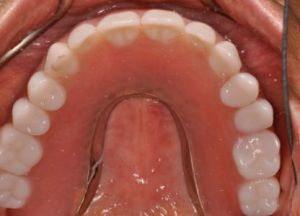 Implant Retained Removable Dentures
