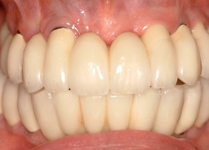 Photo Gallery of Teeth