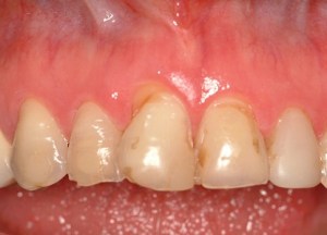 Before Crowns Case Study Photo