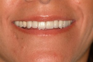 After Crowns Case Study Photo