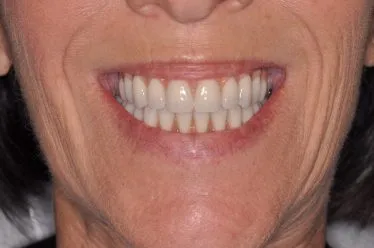 After Teeth in a Day Case Study Photo