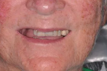 Before Teeth in a Day Case Study Photo