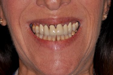 Before Teeth in a Day Case Study Photo