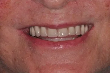 After Teeth in a Day Case Study Photo